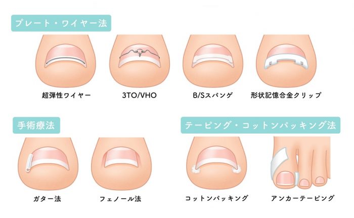 一般的な陥入爪（かんにゅうそう）と巻き爪の治療法