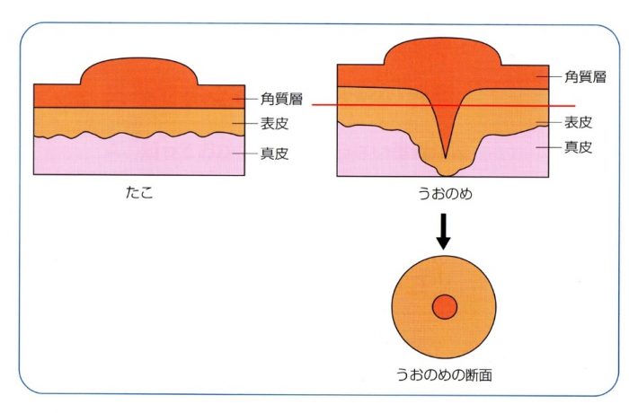 胼胝（たこ）および鶏眼（うおのめ）の基本治療