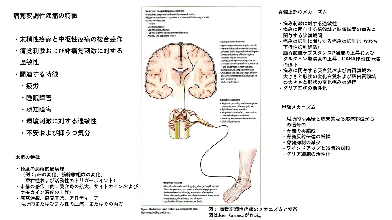 線維筋痛症①（病態） | 喜山整形ハーブクリニック