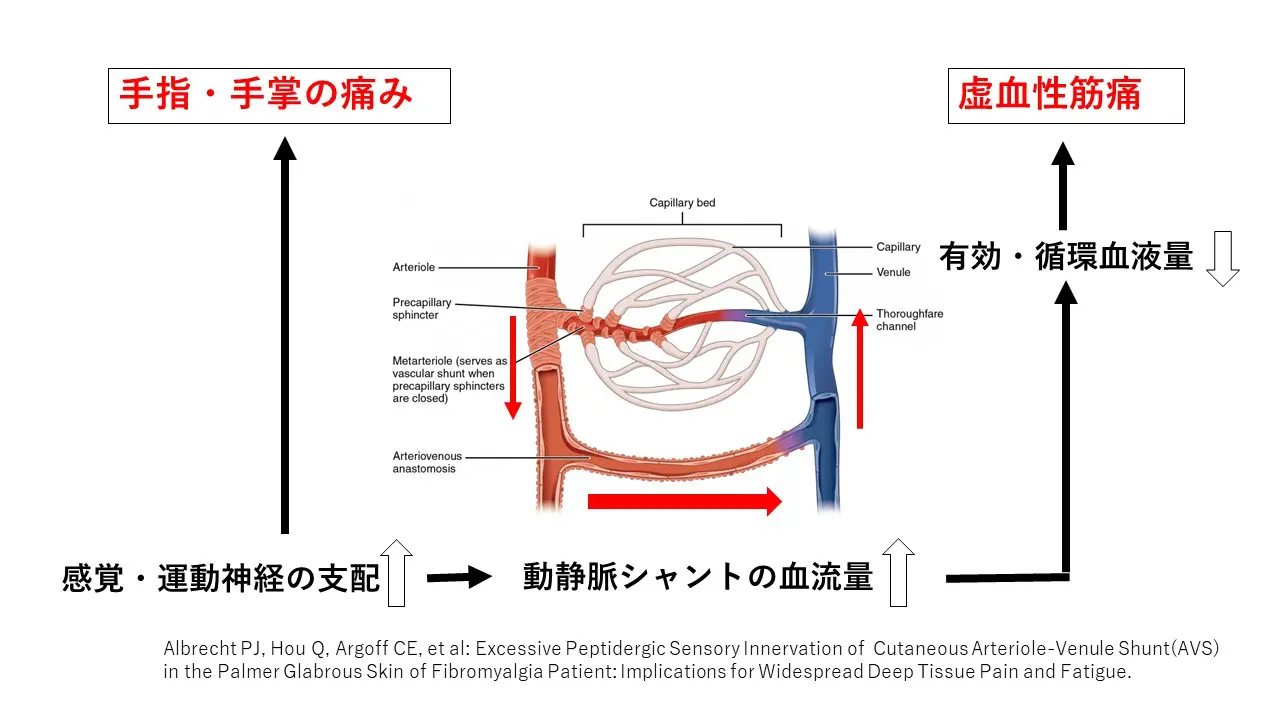 線維筋痛症①（病態） | 喜山整形ハーブクリニック